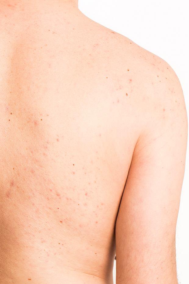 Dermatolog radzi: Co na pryszcze na plecach?