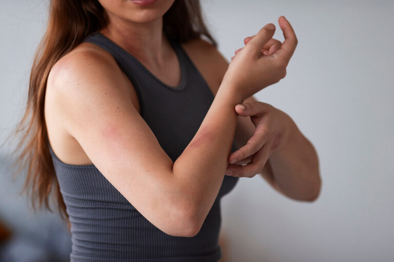 Atopowe zapalenie skóry — przyczyny, objawy, leczenie