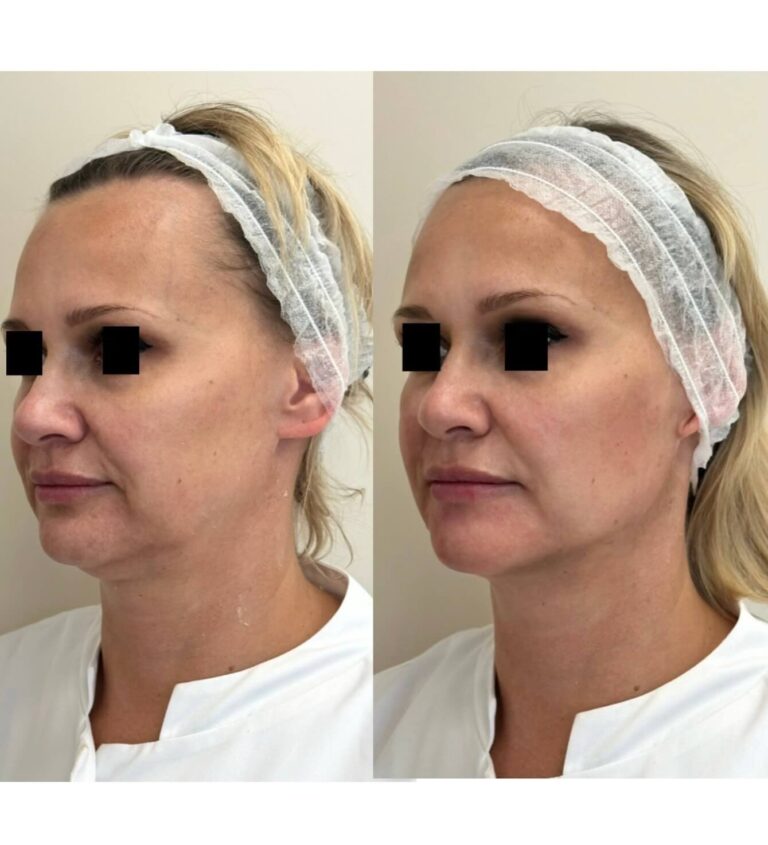 Opadanie owalu, niechirurgiczny lifting twarzy: Codzienna Praktyka